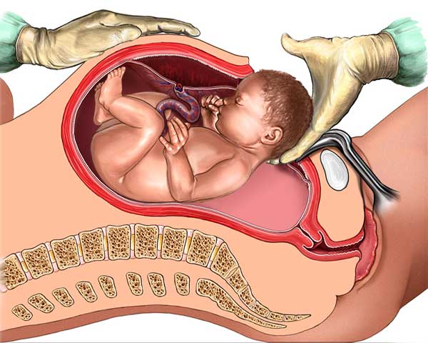 cesarean-delivery